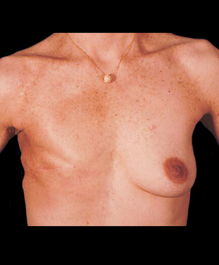 Breast Reconstruction Before